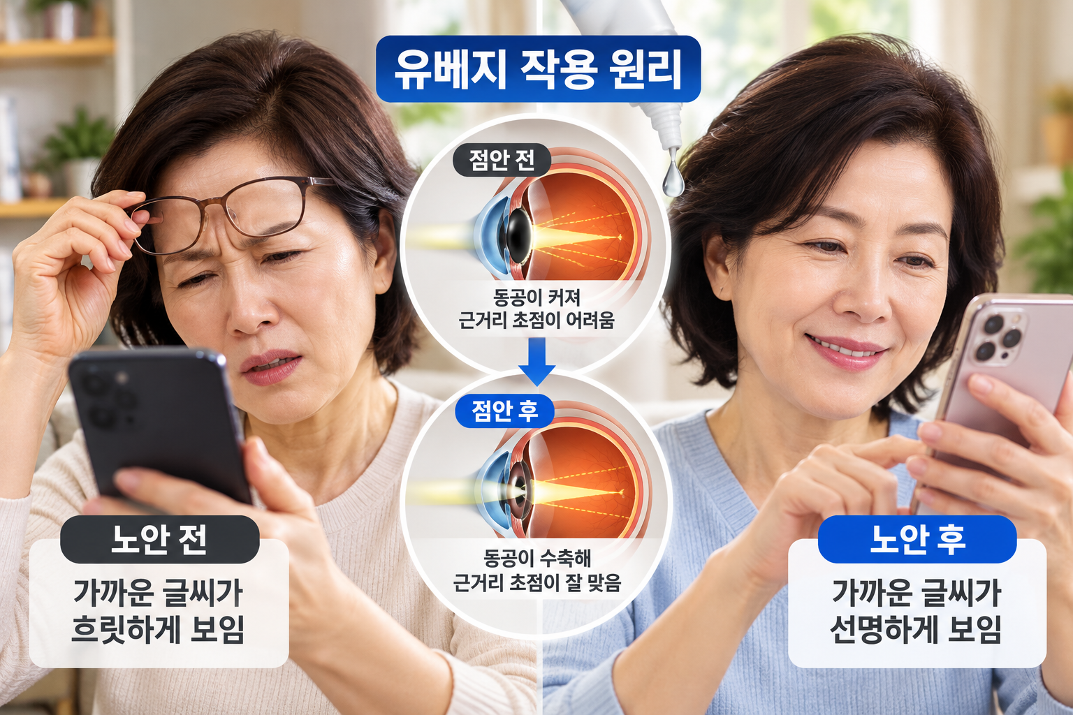 노안 치료제 유베지 점안 전후 동공 수축 원리와 스마트폰 근거리 시력 개선 비교