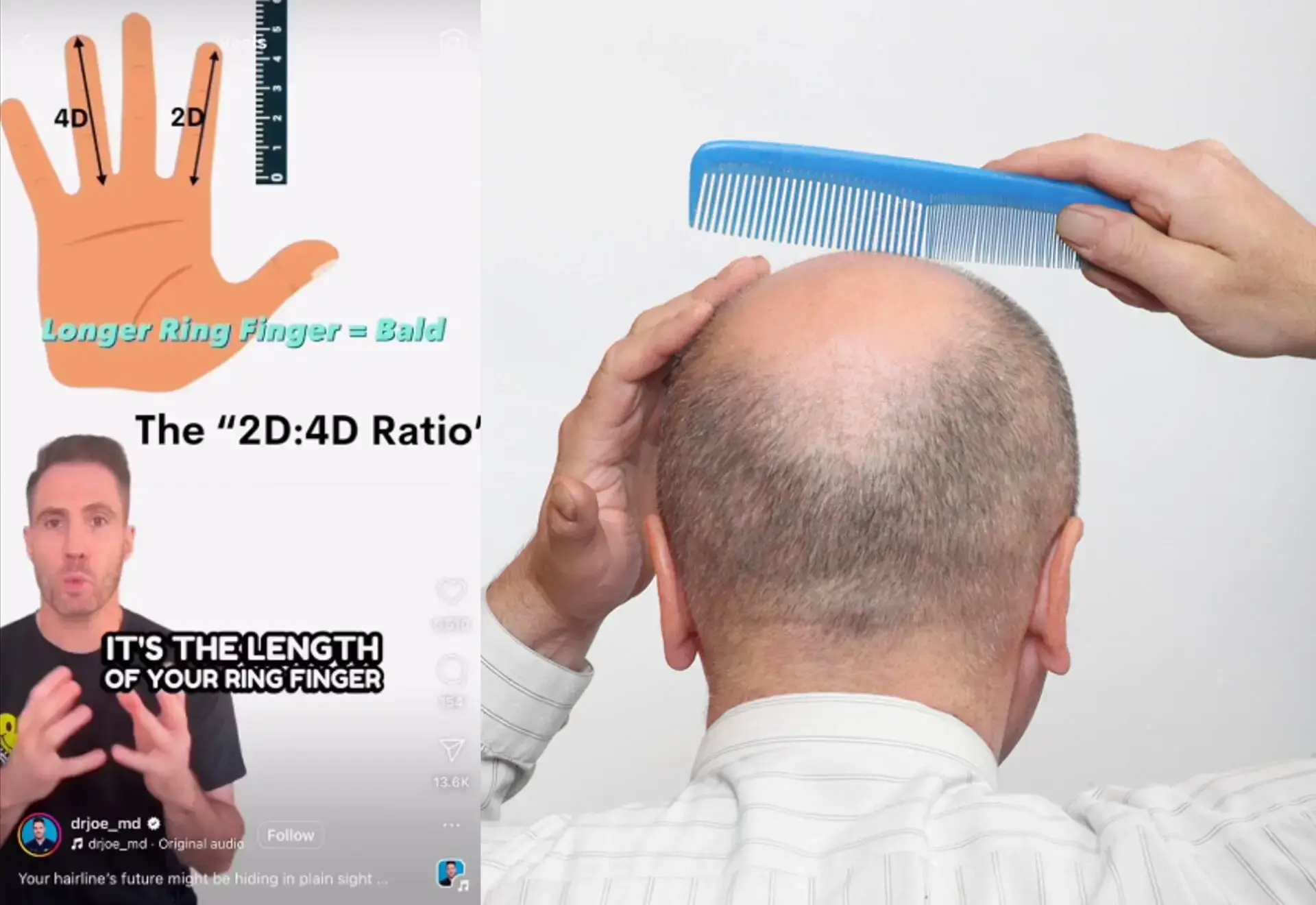 대머리 될 상인가? 손가락으로 확인하는 방법!