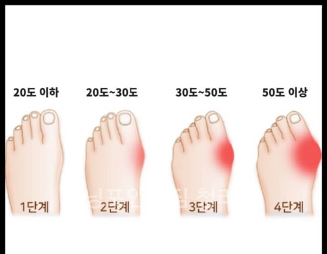 무지외반증의 치료