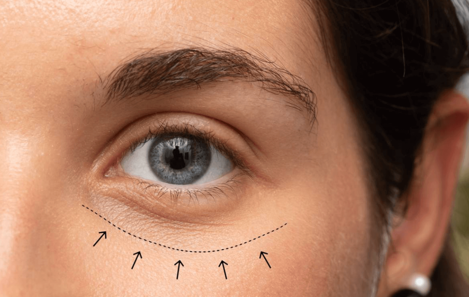 하안검 수술비용