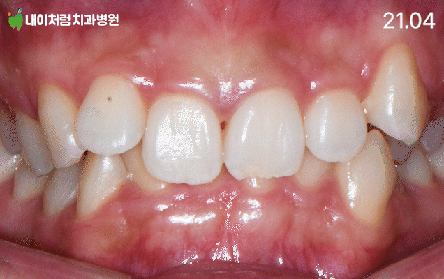 이수역치과 악궁확장장치 사용 후 공간이 확보되며 앞니 쪽이 열린 모습