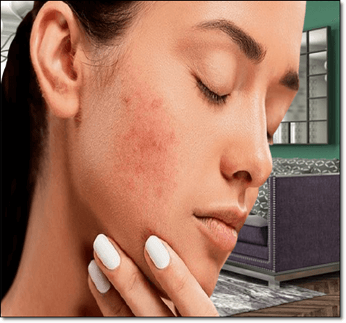 다낭성난소증후군 여드름