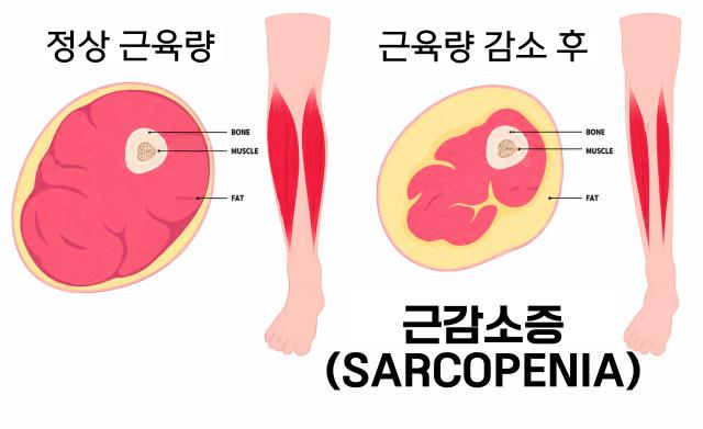 근감소증에 좋은 하체운동 노인 필수 운동