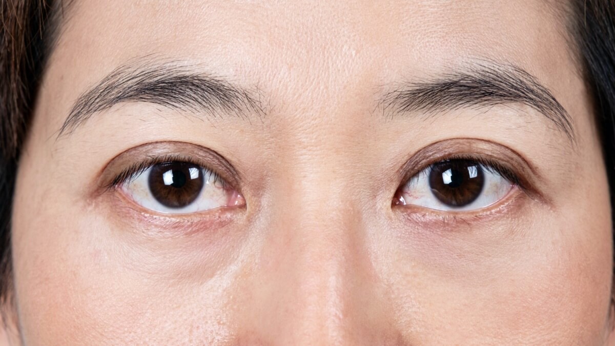 다크서클과-눈가주름이-생긴-여성