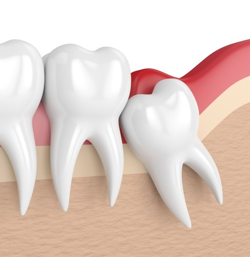 사랑니 발치후 식사 메뉴 음식 종류 통증 시간 양치 언제 후기
