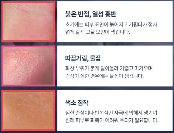 저온화상 증상