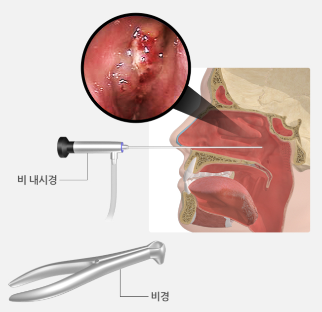 부비동암-비강암-증상-원인-진단-(+비염과-차이점-)