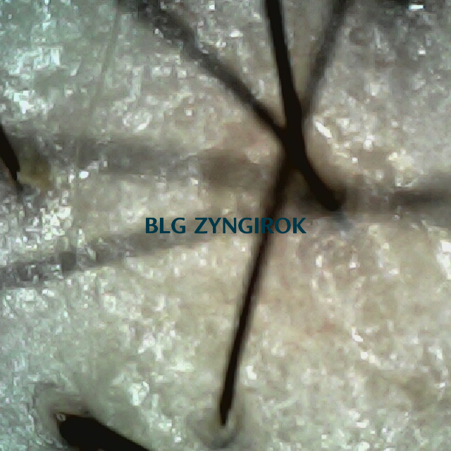 탈모 극복 프로젝트 - 정수리와 이마 사이 두피 모습이다.