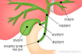 쓸개(담낭) 제거수술