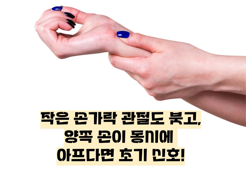 류마티스 관절염 초기증상