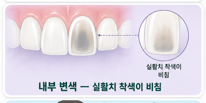 치아 내부 변색(실활치)