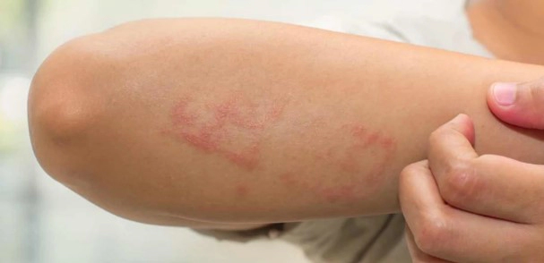 모공각화증 치료 방법 7가지 및 모공각화증 로션 미스트 추천 (+자주묻는질문)