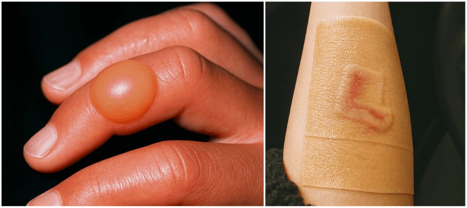 화상물집-메디폼