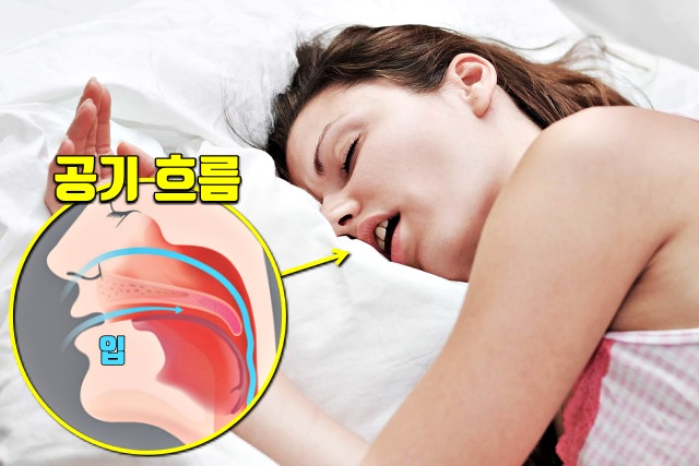 입으로 숨쉬면, 코골이, 수면무호흡증 증세 자가진단, 양압기, 수면 습관, 건강