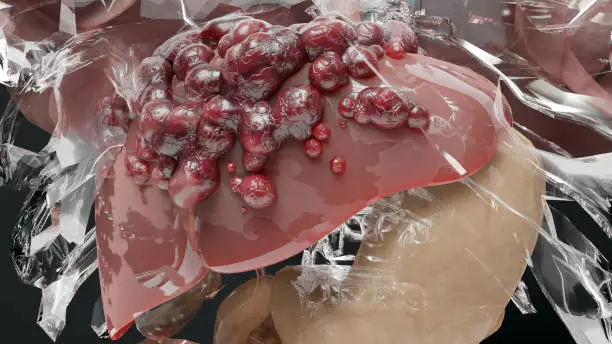 간암 초기증상과 원인 단계별 증상 (1기 ~4기) 대해 자세히 알아볼 거예요. 간암은 우리나라에서 발생하는 암 중에서 꽤 높은 비율을 차지해요. 대부분의 경우&#44; 만성 간 질환자들&#44; 특히 B형 또는 C형 간염을 가진 사람들에게서 많이 나타난답니다.