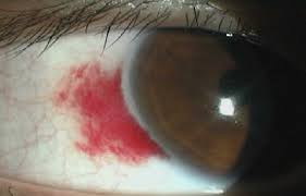 눈 실핏줄이 터지는 이유