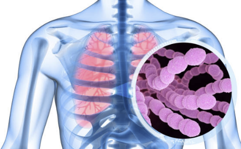 폐렴구균 예방접종 횟수 비용 무료 접종후 주의사항 총정리