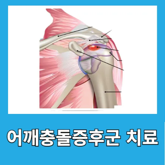 어깨충돌증후군 치료방법