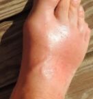 발등이 아픈 이유