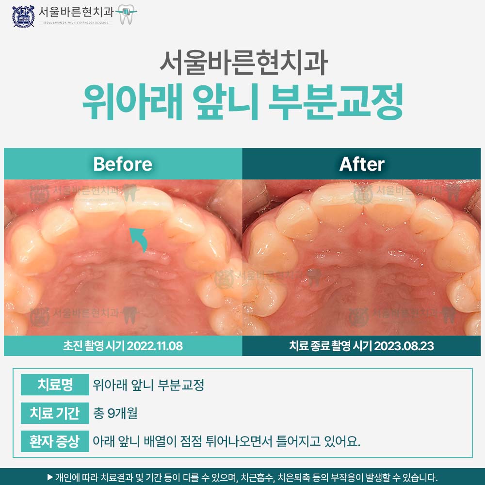 마린시티치아교정