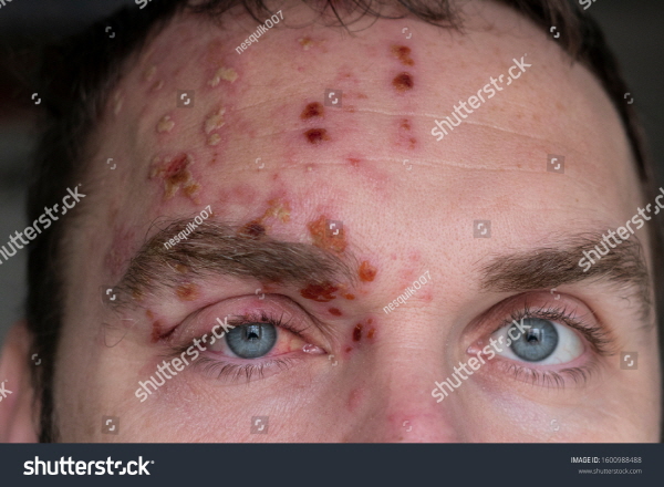 대상포진 원인