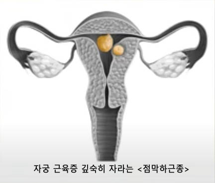 점막하근종 증상 이미지