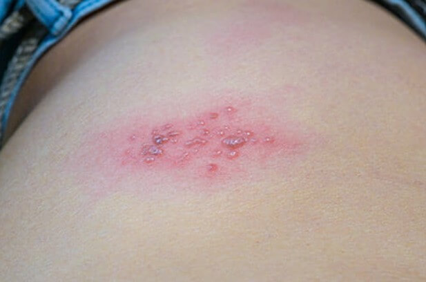 대상포진 초기증상 대상포진 조기치료 대상포진 초기증상 및 조기치료