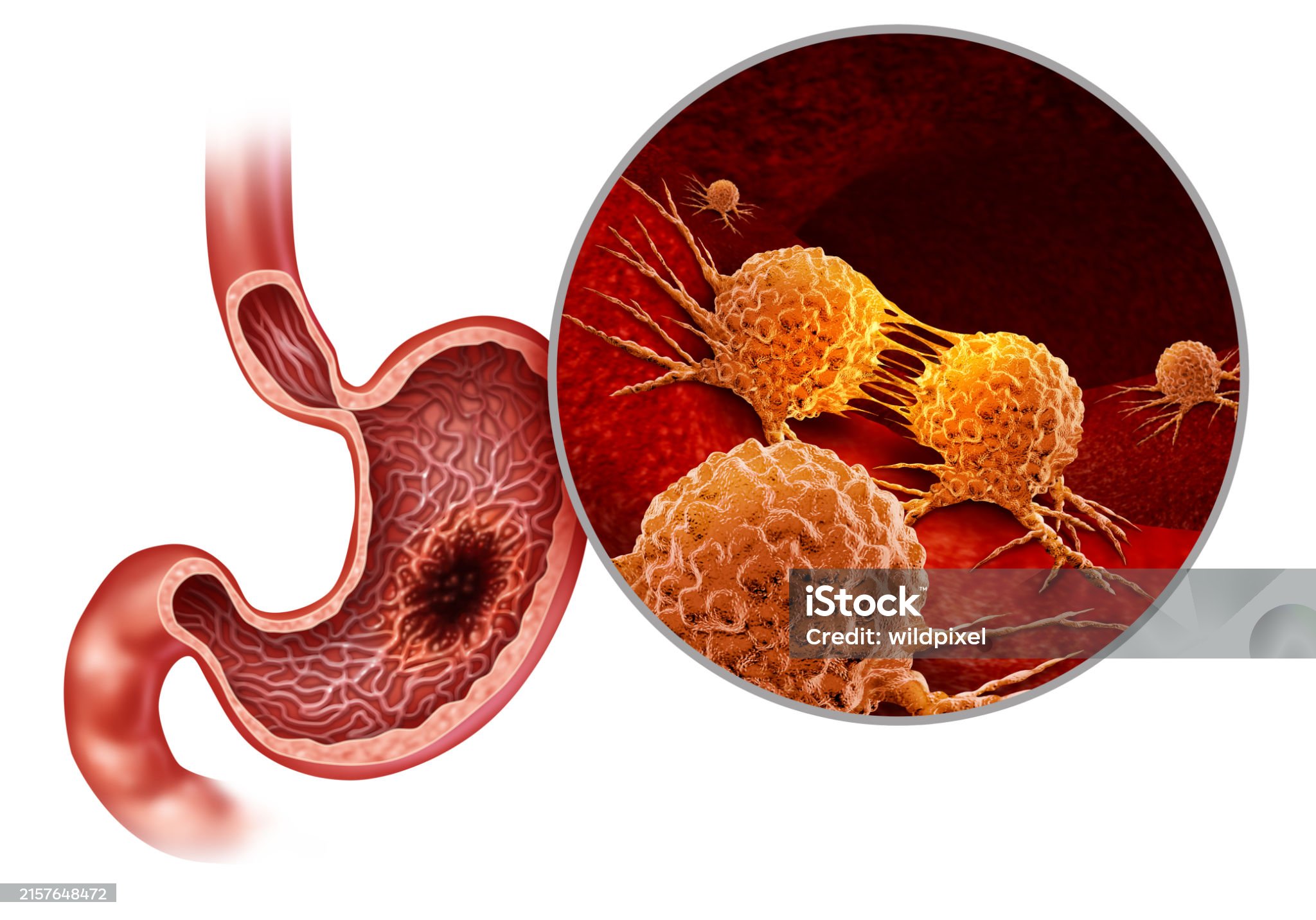 위암-관련-사진