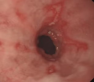 역류성식도염 발병 사진