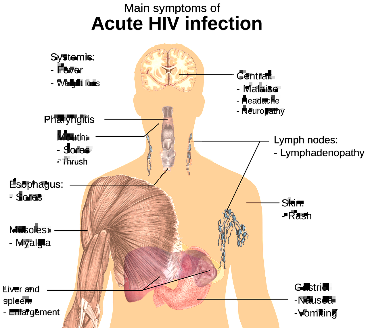 림프종 (lymphoma) 원인, 증상 및 치료법