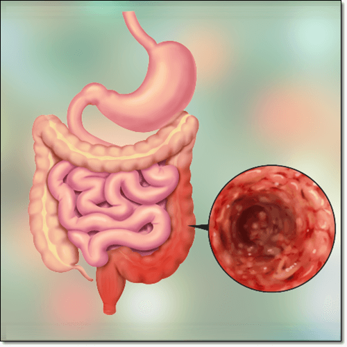 장누수 증후군으로 장 투과성이 높아진 이미지
