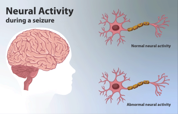 의학용어 absence seizure 뜻 소발작 치료제