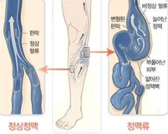 하지 정맥류 증상 치료방법과 예방 생활습관_5