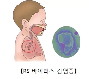 rs-바이러스-감염증