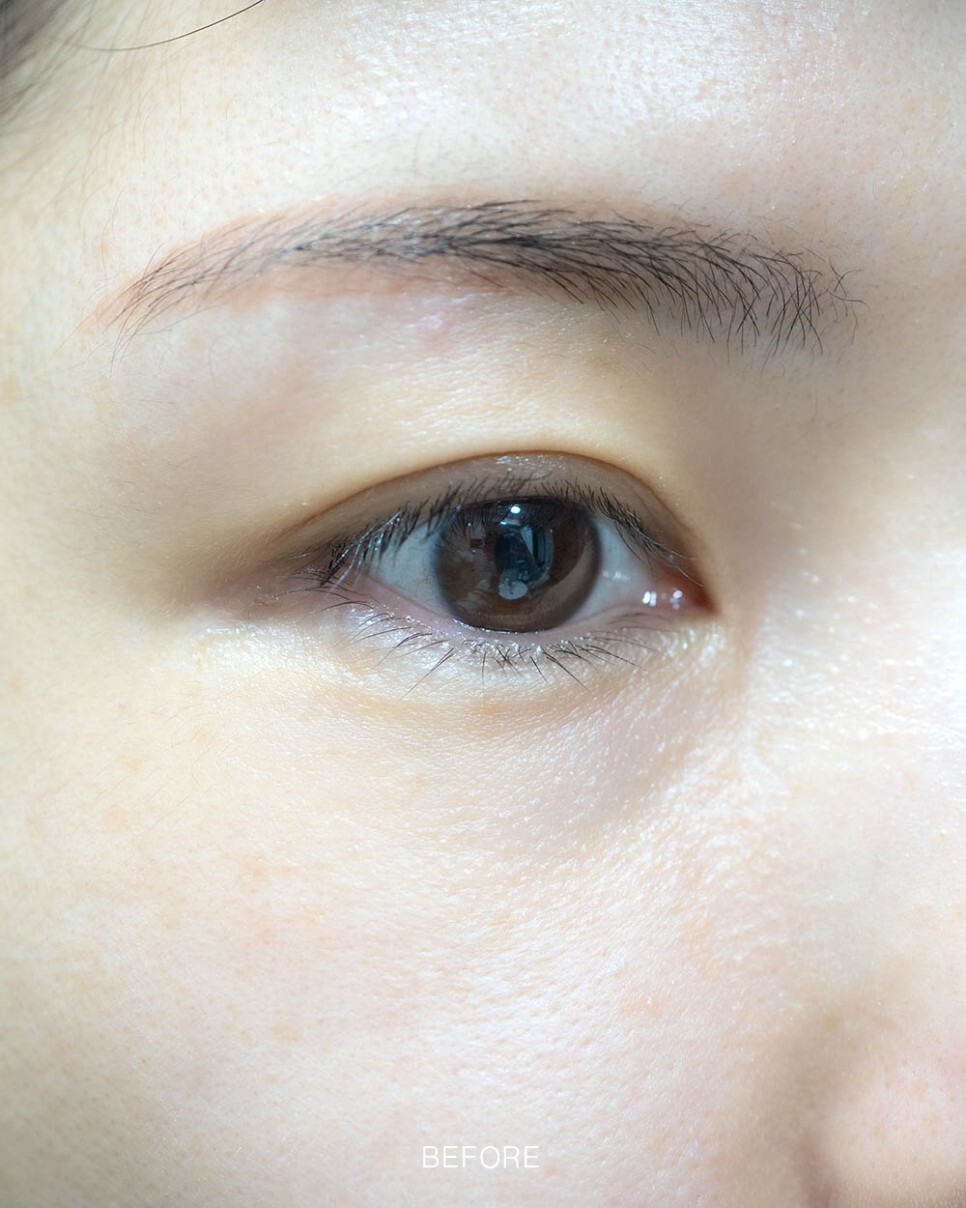 눈밑지방재배치 후기