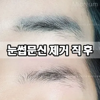 눈썹 문신 제거 방법 꿀팁_14