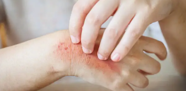 빨개진 손등 긁는사진