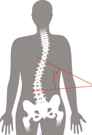 척추측만증을-보여주는-그림