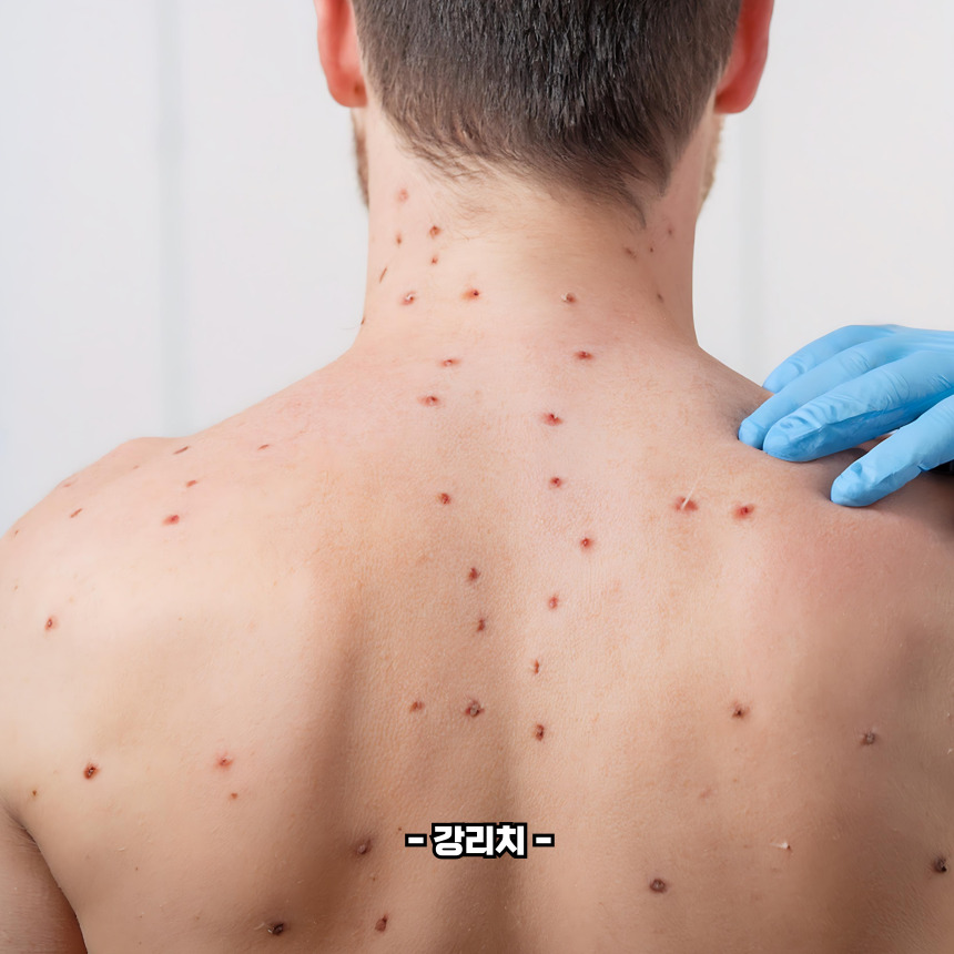 여드름 부위별 원인