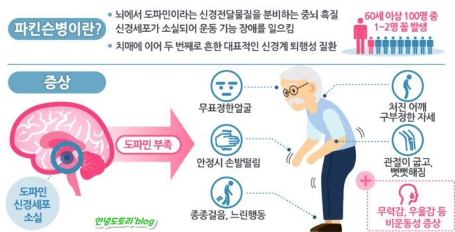 파킨슨병 증상