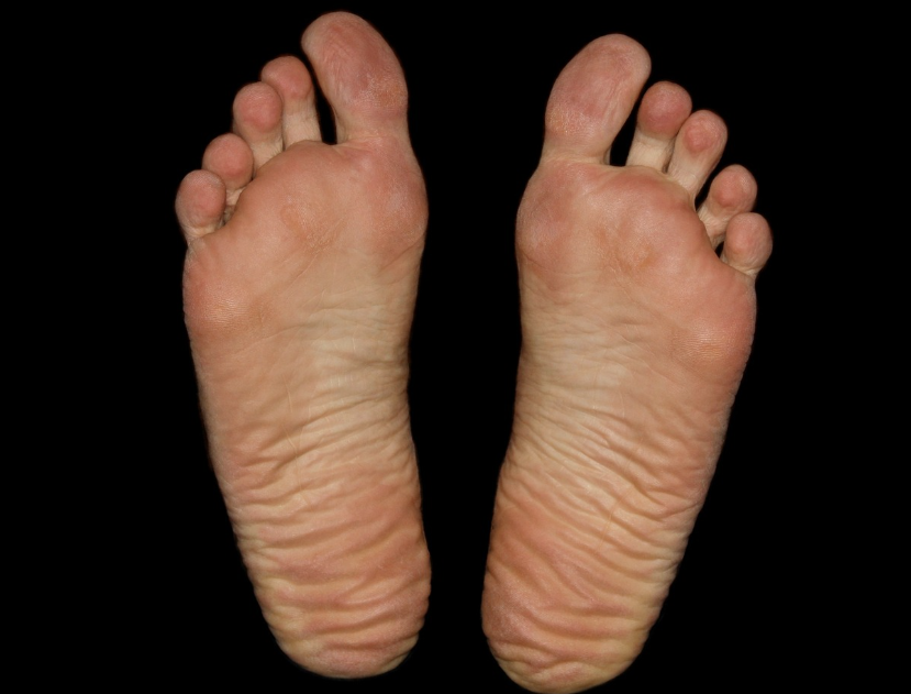 무좀 걸린 성인 발