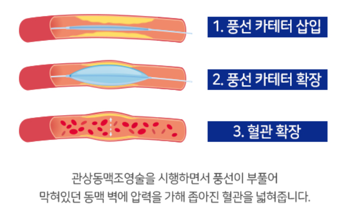 협심증-심근경색-차이-관상동맥-중재술-명의