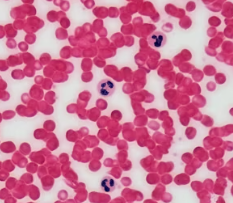 빈혈 증상 원인 치료 방법