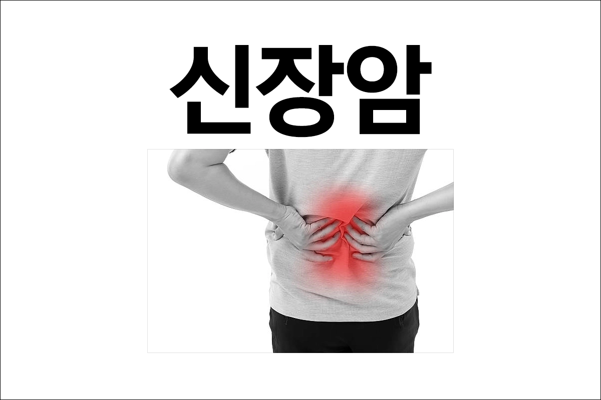 신장암 특징 원인 증상 치료 예방