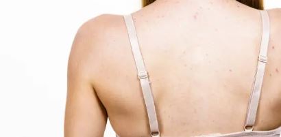 등에 여드름 난 사진