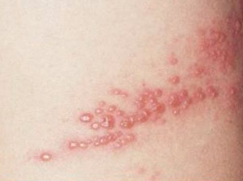 대상포진 초기증상 4가지 ❘ 진료병원,예방접종 지원 정보