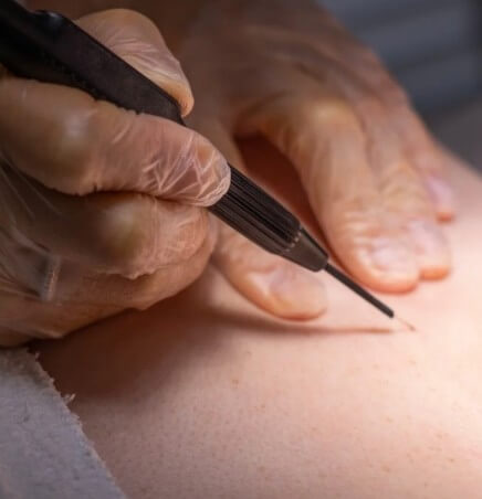 레이저 수술 중인 모습