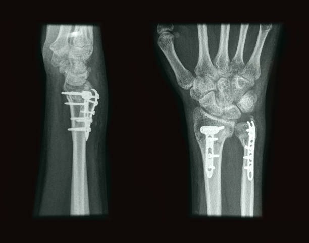 척골충돌증후군 원인