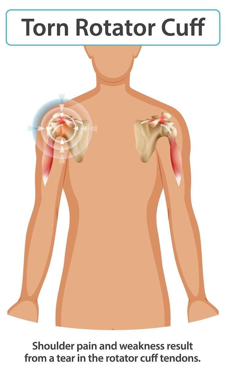 어깨회전근개파열