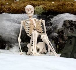 퇴행성 관절염 치료제 예방법 진단기준